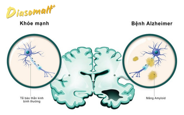 Bệnh Alzheimer - TOP 10 bệnh gây tử vong 2024